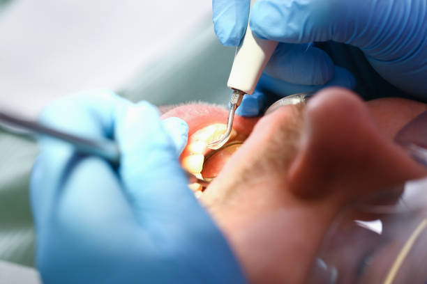 Best Emergency Wisdom Tooth Extraction in Americus, GA